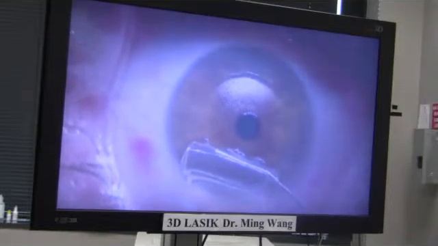 Tina Nolan 3D Laser Raindrop Done By Dr  Ming Wang, Harvard & MMIT MD; PhD
