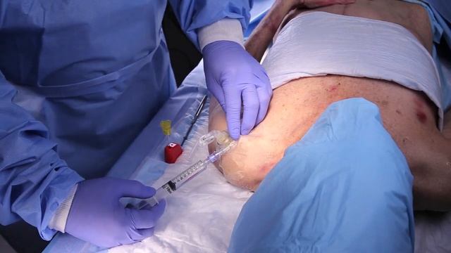 Arrow® EZ-IO® Proximal Humerus Insertion Video Cadaveric