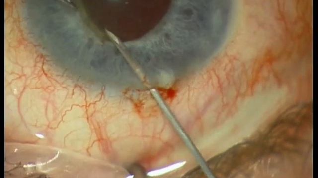 Part V: Iris Capture