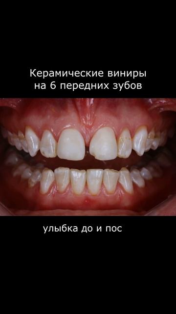 Женские истории. Виниры E Max при флюорозе и диастеме