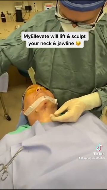 Neck Lipo And MyEllevate By Dr. Burroughs From Springs Aesthetics In Colorado Springs
