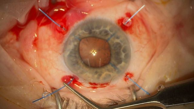IRIS HOOKS -  Top Tips In Cataract Surgery