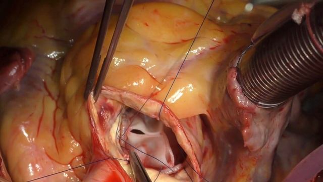 Aortic Valve Replacement Using The Biological Prosthesis 