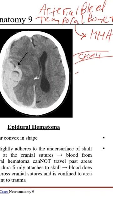 Epidural Hematoma Explained