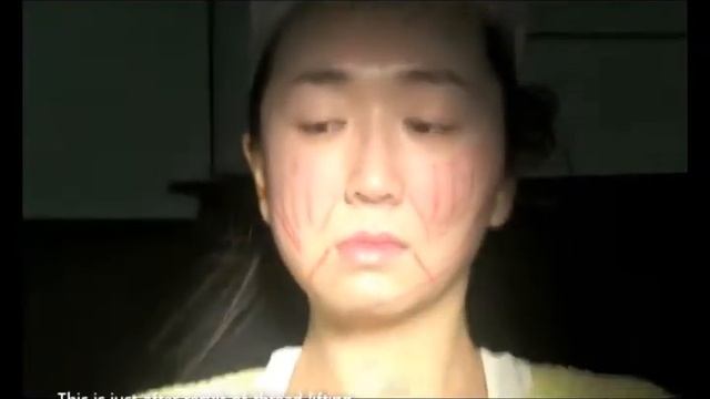 AVI Phoenix Procedure   Dr  Kang