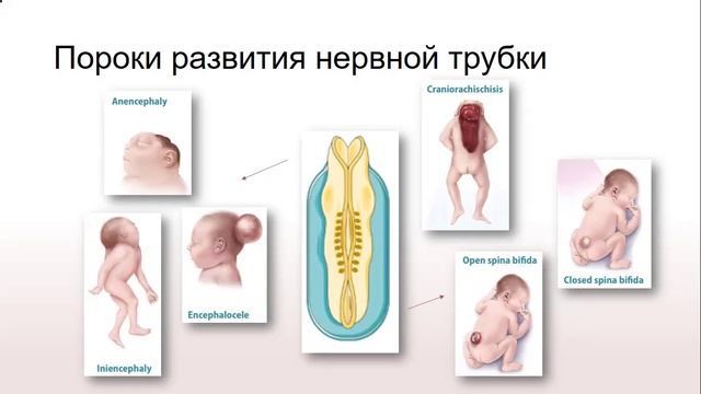 Нарушение эмбрионального развития при Spina Bifida