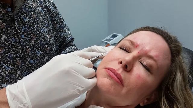 Dysport For Wrinkles Made Easy, Dr Weiner