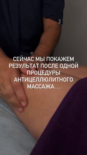 1 сеанс антицеллюлитного массажа в Алтеро