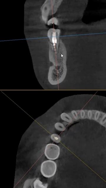 Визуализация перелома корня зуба #стоматология #vatech