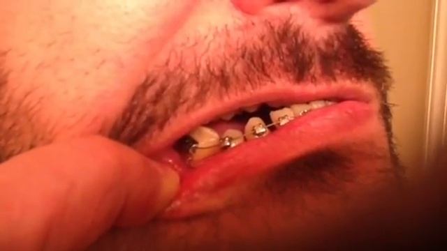 Damon Braces 5 Months