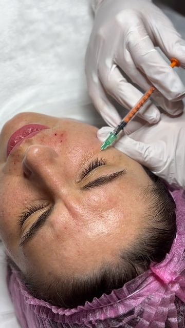 Мезотерапия. Техника поверхностный наппаж