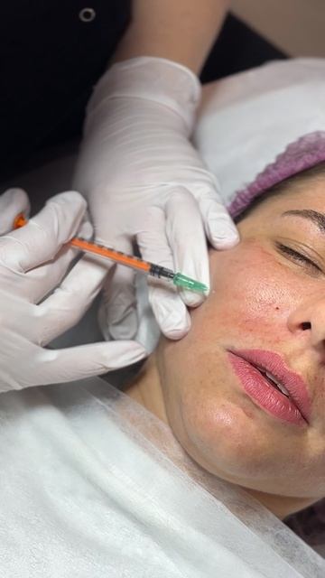 Мезотерапия. Техника поверхностный наппаж