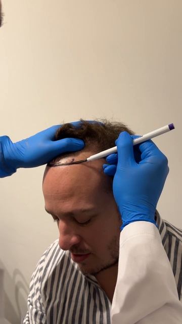 Hair Transplant In Turkey L Пересадка волос  #hairtransplantturkey #пересадк?