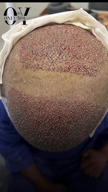 💥Пересадка волос в Москве