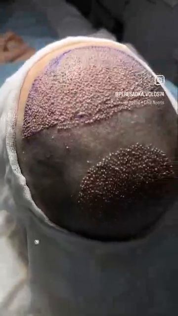 Пересадка волос Челябинск | Процесс работы