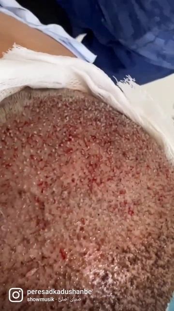 #россия #пересадкаволос #таджикистан #новосибирск #transp