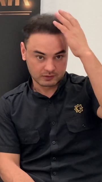 Пересадка волос результат #hairtransplant #пересадкаволос #sho