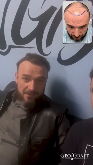 ПЕРЕСАДКА ВОЛОС в GGMED, результат ДО/ПОСЛЕ #81