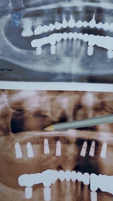 Закончили операцию. Удалили 7 зубов. Синусы почти 6 грамм. Имплантация зубов.