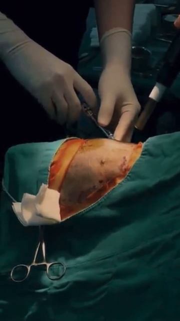 Пересадка волос в Южной Корее Https://seoulguidemedical.com/ #пласти