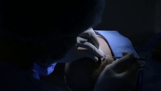 Soch Ekish Jarayoni / пересадка волос / Hair Transplant