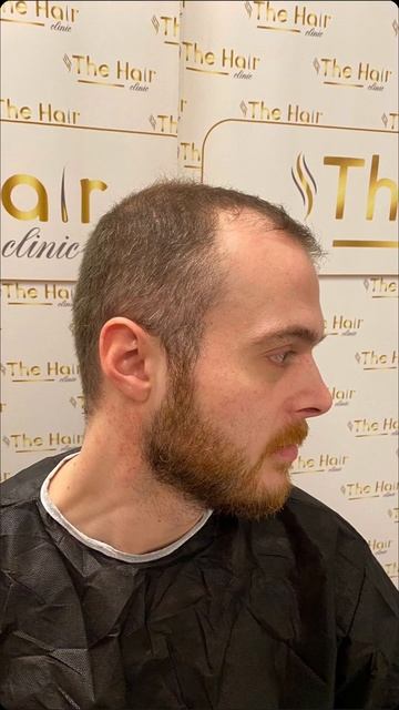 Спустя 2 месяца. Пересадка волос. #стамбул #туризм #турц