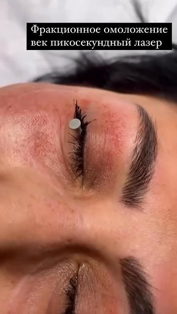 Действует скидка при покупке курса из 3 х процедур на Л