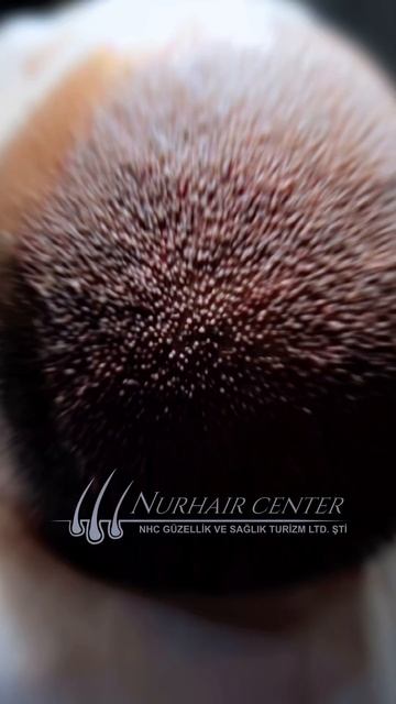 #shorts #hair #hairtransplant #пересадкаволос