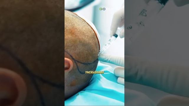 Пересадка волос Амирану Сардарову #амирансардаров #пе