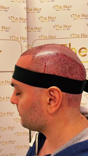 1-й день после пересадки. #пересадкаволос #hairtransplant #тур?