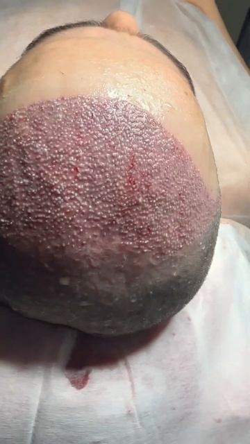 пересадка волос занимает 1 день, и ваши волосы останут?