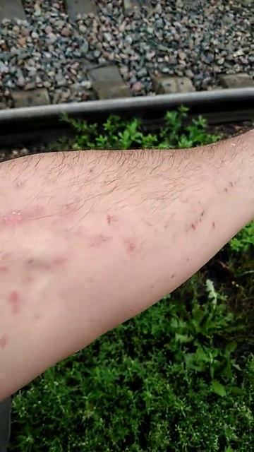 ########борщевик его последствия#######