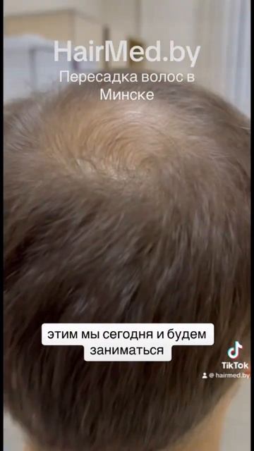Пересадка | Трансплантация волос в Минске