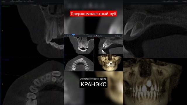 #сверхкомплектный #зуб у ребёнка