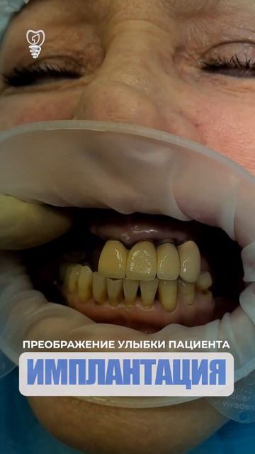Преображение улыбки пациента. Transformation Of The Patient's Smile. Implantation.