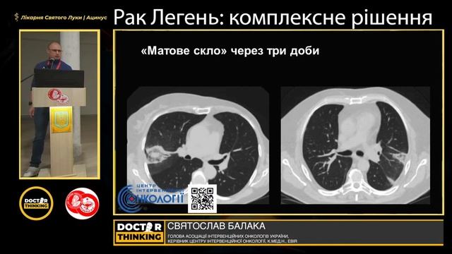 Радіочастотна абляція органів грудної клітки