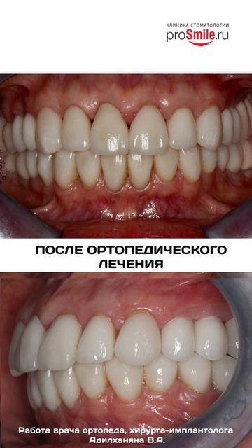 Клинический случай комплексной реабилитации пациентки 60 лет с заболеванием пародонта.