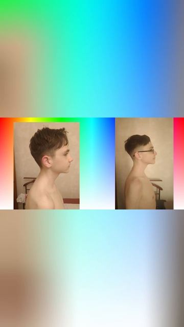 Лечение деформации черепа, без шлема и операций