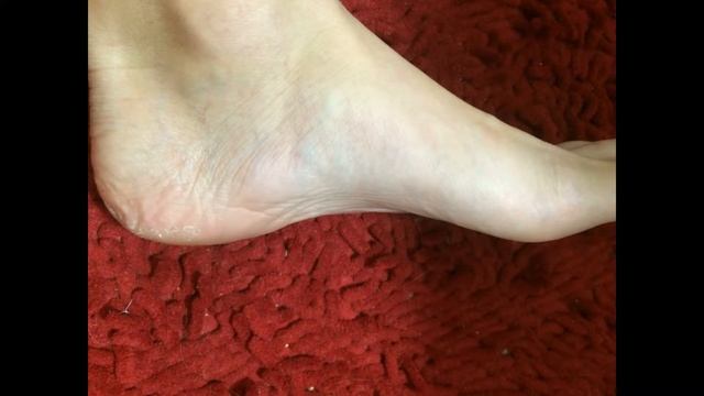 Eco Life Probiotic Cosmetics примеры с псориазом