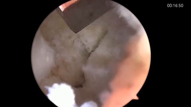 UBE/BESS. Латеральный стеноз L4 L5.