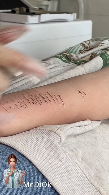 Удаление шрамов лазером