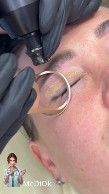 Лазерная шлифовка век