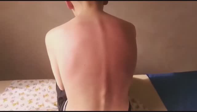 Лечение шейных грыж, шейного остеохондроза