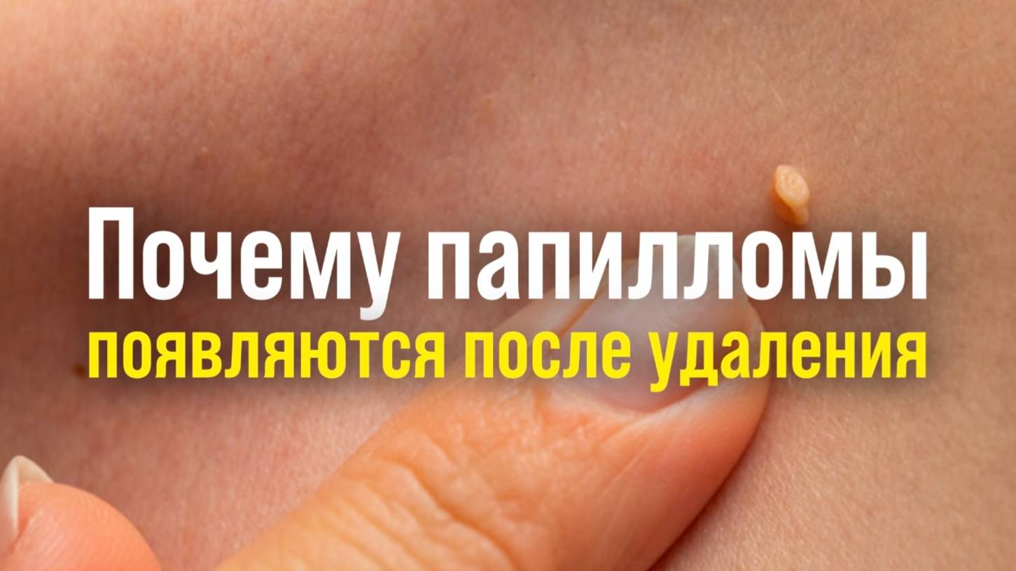 Вы удалили папилломы, пропили курс препаратов, даже старались соблюдать диету...