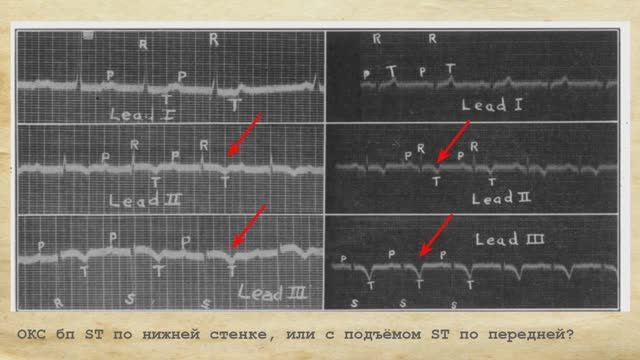 Как ЭКГ стала 12-канальной: отведения Уилсона и Голдбергера