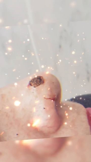 Удаление родинки до/после