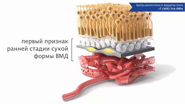 ВМД  Форма, стадии, лечение ВМД