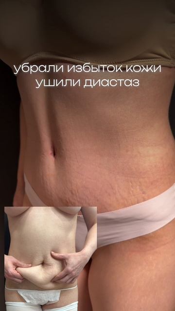 Пластика живота - абдоминопластика. Пластический хирург Баков Вадим Сергеевич