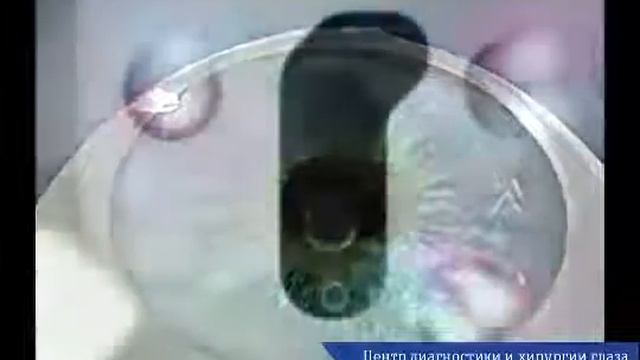 Лазерная коррекция зрения