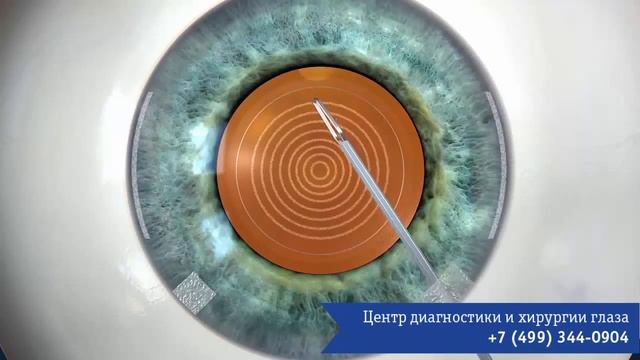 Удаление катаракты лазером